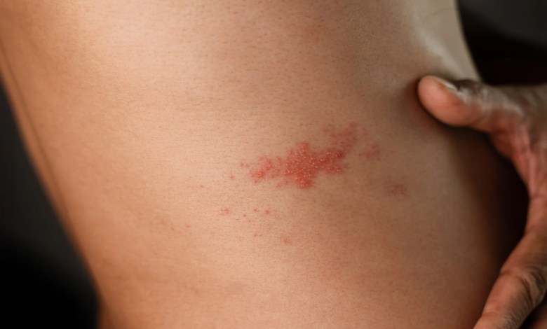 Herpes zoster vaccines could be a secret weapon to prevent heart attacks Herpes zoster vaccines could be a secret weapon to prevent heart attacks