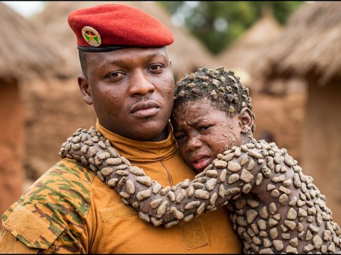 Ibrahim Traoré a aidé un garçon orphelin pauvre de 13 ans qui a contracté une maladie étrange Ibrahim Traoré a aidé un garçon orphelin pauvre de 13 ans qui a contracté une maladie étrange