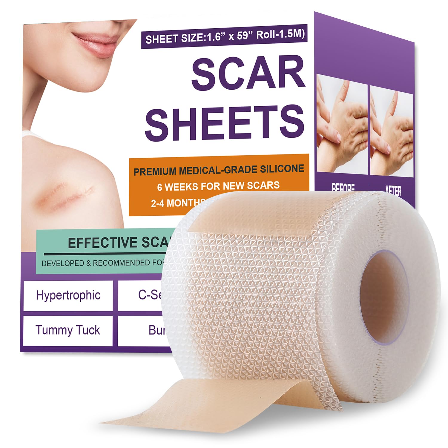 Silicone Scar Sheets,Silicone Scar Tape,Scar Tape For Surgical Scars,Silicone Scar Removal Strips For Surgical,C-Section,Tummy Tuck,Keloid Scars(1.6″X 59″ Roll-1.5M) Silicone Scar Sheets,Silicone Scar Tape,Scar Tape For Surgical Scars,Silicone Scar Removal Strips For Surgical,C-Section,Tummy Tuck,Keloid Scars(1.6″X 59″ Roll-1.5M)