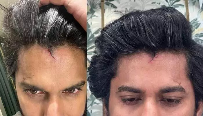 తల పగిలి కుట్లు పడ్డా కూడా షూటింగ్లో పాల్గొన్న స్టార్ హీరో.. నీ డెడికేషన్కు టేక్ ఎ బౌ అంటూ ఫ్యాన్స్ కామెంట్స్(పోస్ట్) తల పగిలి కుట్లు పడ్డా కూడా షూటింగ్లో పాల్గొన్న స్టార్ హీరో.. నీ డెడికేషన్కు టేక్ ఎ బౌ అంటూ ఫ్యాన్స్ కామెంట్స్(పోస్ట్)