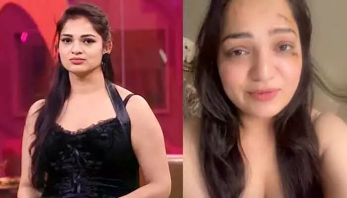 Bigg Boss Ashwini Sree Injured in Accident: Viral Video Shocks Fans Bigg Boss Ashwini Sree Injured in Accident: Viral Video Shocks Fans