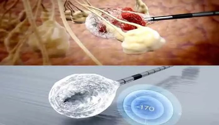 క్యాన్సర్కు చల్లటి చికిత్స: గడ్డకట్టి కణితిని ఖతం చేసే విప్లవం! క్యాన్సర్కు చల్లటి చికిత్స: గడ్డకట్టి కణితిని ఖతం చేసే విప్లవం!