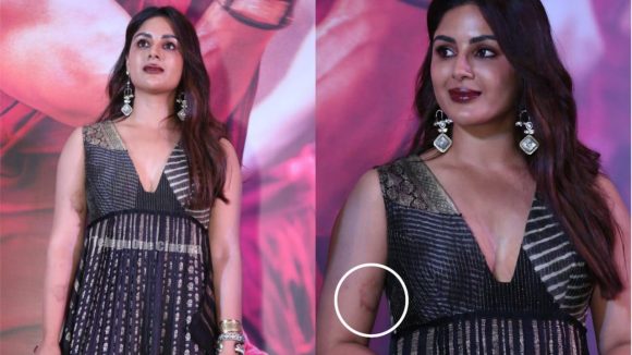 Samyuktha Menon Injured on 'Swayambhu' Set: Fans Express Concern Amidst Film Promotions Samyuktha Menon Injured on 'Swayambhu' Set: Fans Express Concern Amidst Film Promotions