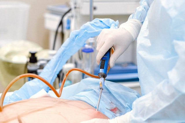 liposuction liposuction