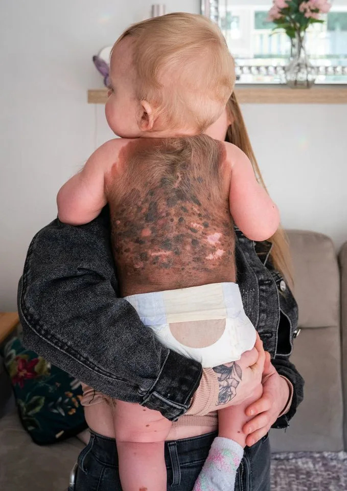 10-Month-Previous’s Physique Lined in ‘Painful Bleeding Lesions’ from Uncommon Cancerous Birthmark 10-Month-Previous’s Physique Lined in ‘Painful Bleeding Lesions’ from Uncommon Cancerous Birthmark