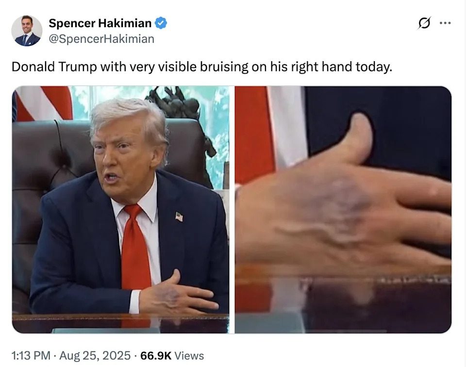 Trump’s Bruised Hand Seen With out Make-up—and It Appears to be like Fairly Unhealthy Trump’s Bruised Hand Seen With out Make-up—and It Appears to be like Fairly Unhealthy