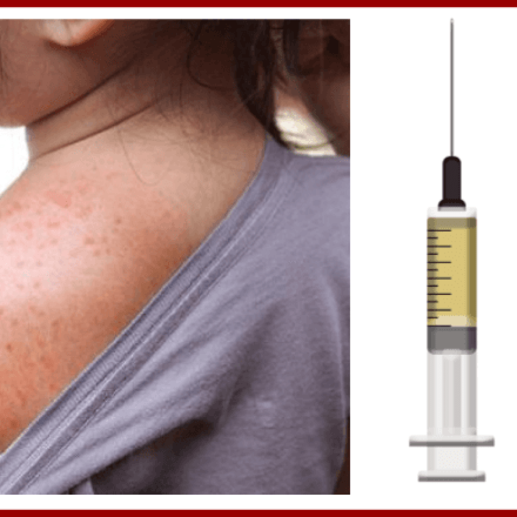 Case Study – Measles, Immunity, and Vaccines Case Study – Measles, Immunity, and Vaccines
