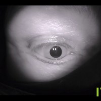 Positiver Dix-Hallpike Test – Lagerungsschwindel im linken, hinteren Bogengang Positiver Dix-Hallpike Test – Lagerungsschwindel im linken, hinteren Bogengang