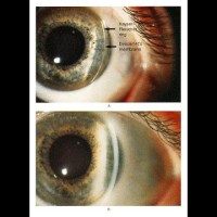 Kayser Fleischer Ring bei Patient mit Morbus Wilson Kayser Fleischer Ring bei Patient mit Morbus Wilson