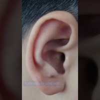 Tinnitus EXPOSED – Surprising Causes of Ringing in Ears #8 Meniere’s & Labyrinthitis Tinnitus EXPOSED – Surprising Causes of Ringing in Ears #8 Meniere’s & Labyrinthitis