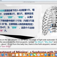 Yang GuanHu: „Treatment of Meniere’s Syndrome with Traditional Chinese Medecine“ Yang GuanHu: „Treatment of Meniere’s Syndrome with Traditional Chinese Medecine“