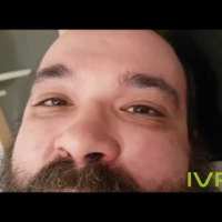 Positiver Dix-Hallpike Test – Lagerungsschwindel im linken, hinteren Bogengang Positiver Dix-Hallpike Test – Lagerungsschwindel im linken, hinteren Bogengang