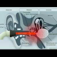 Tinnitool EarLaser Anwendung Tinnitool EarLaser Anwendung