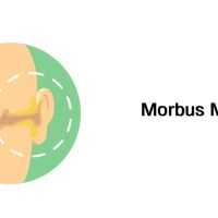 Morbus Menière – Erkrankungen der Ohren (mit Infoleiste) Morbus Menière – Erkrankungen der Ohren (mit Infoleiste)