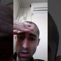 ENT – Meniere and VEMP test ENT – Meniere and VEMP test