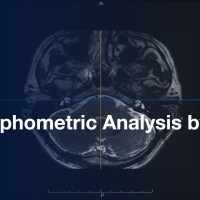 Morphometric Analysis: Human Cranial Nerves (Menière’s Disease & Normal Ears by MRI) Morphometric Analysis: Human Cranial Nerves (Menière’s Disease & Normal Ears by MRI)