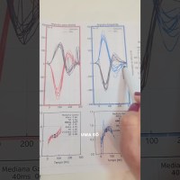 Exame vhit na doença de meniere Exame vhit na doença de meniere