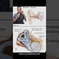 Ménière’s disease – Vertigo/dizziness, ringing in the ears (tinnitus), fullness in the ear, fatigue. Ménière’s disease – Vertigo/dizziness, ringing in the ears (tinnitus), fullness in the ear, fatigue.