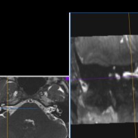 Schwindelerkrankungen: Die Vestibularisparoxysmie | Dr. Bodo Schiffmann – Schwindelambulanz Sinsheim Schwindelerkrankungen: Die Vestibularisparoxysmie | Dr. Bodo Schiffmann – Schwindelambulanz Sinsheim