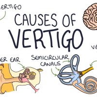 Understanding the Causes of Vertigo Understanding the Causes of Vertigo
