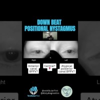 Downbeat nystagmus in Dix-Hallpike test – central or peripheral? #bppv #vestibularrehabilitation Downbeat nystagmus in Dix-Hallpike test – central or peripheral? #bppv #vestibularrehabilitation