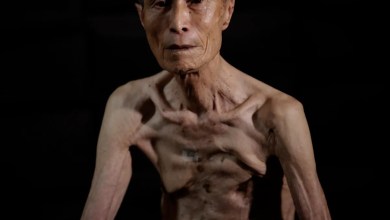 Powerful AP photos show the scars of a survivor of the Nagasaki atomic bombing Powerful AP photos show the scars of a survivor of the Nagasaki atomic bombing