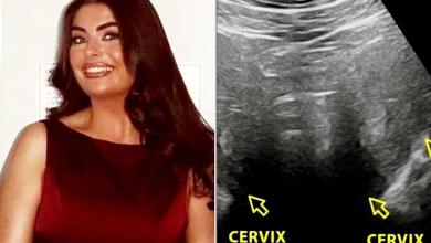 Woman Had Intense Periods. After Surgery at Age 19, She Discovered She Has an Extremely Rare Condition — 2 Wombs (Exclusive) Woman Had Intense Periods. After Surgery at Age 19, She Discovered She Has an Extremely Rare Condition — 2 Wombs (Exclusive)