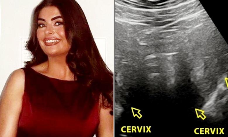 Woman Had Intense Periods. After Surgery at Age 19, She Discovered She Has an Extremely Rare Condition — 2 Wombs (Exclusive) Woman Had Intense Periods. After Surgery at Age 19, She Discovered She Has an Extremely Rare Condition — 2 Wombs (Exclusive)