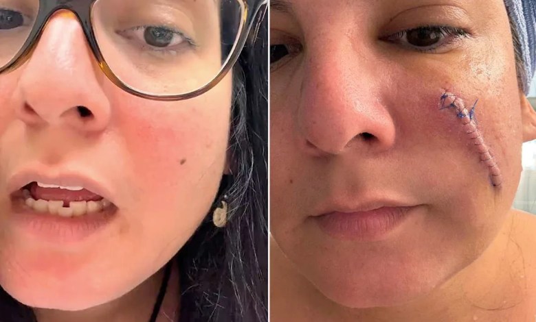 Woman Says She Felt ‘Pretty Good’ After Surgery to Remove Cancerous Mole on Her Face — Until She Took Bandage Off (Exclusive) Woman Says She Felt ‘Pretty Good’ After Surgery to Remove Cancerous Mole on Her Face — Until She Took Bandage Off (Exclusive)