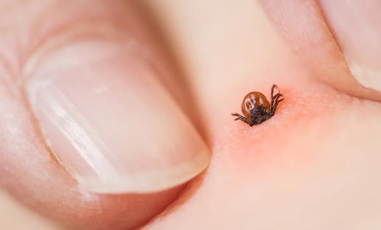 So, you got bit by a tick. Here’s exactly what to do next. So, you got bit by a tick. Here’s exactly what to do next.