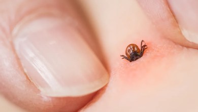 So, you got bit by a tick. Here’s exactly what to do next. So, you got bit by a tick. Here’s exactly what to do next.