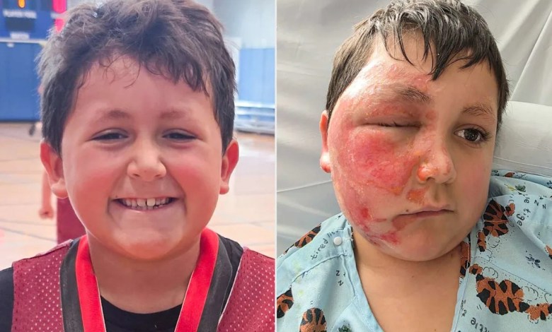 9-Year-Old Boy Left with Severe Burns on Face After Trying Dangerous Social Media Trend Becomes 4th Child to Need Treatment from Local Hospital 9-Year-Old Boy Left with Severe Burns on Face After Trying Dangerous Social Media Trend Becomes 4th Child to Need Treatment from Local Hospital