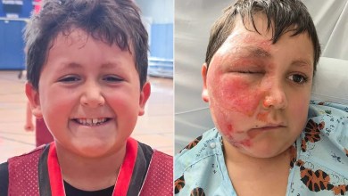 9-Year-Old Boy Left with Severe Burns on Face After Trying Dangerous Social Media Trend Becomes 4th Child to Need Treatment from Local Hospital 9-Year-Old Boy Left with Severe Burns on Face After Trying Dangerous Social Media Trend Becomes 4th Child to Need Treatment from Local Hospital