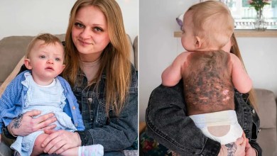 10-Month-Old’s Body Covered in ‘Painful Bleeding Lesions’ from Rare Cancerous Birthmark 10-Month-Old’s Body Covered in ‘Painful Bleeding Lesions’ from Rare Cancerous Birthmark