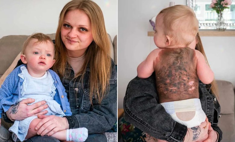 10-Month-Old’s Body Covered in ‘Painful Bleeding Lesions’ from Rare Cancerous Birthmark 10-Month-Old’s Body Covered in ‘Painful Bleeding Lesions’ from Rare Cancerous Birthmark