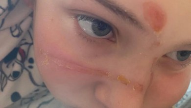 TikTok squishy toy trend caused ‘traumatising’ burns TikTok squishy toy trend caused ‘traumatising’ burns