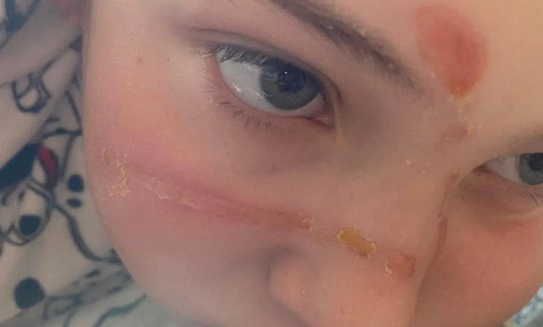TikTok squishy toy trend caused ‘traumatising’ burns TikTok squishy toy trend caused ‘traumatising’ burns