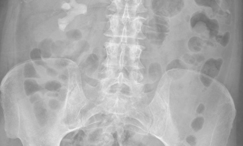 ‘It Was Huge and It Had Horns’ One Women Shared How She Ended up Secretly Growing a 1-Pound Kidney Stone ‘It Was Huge and It Had Horns’ One Women Shared How She Ended up Secretly Growing a 1-Pound Kidney Stone
