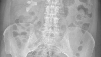 ‘It Was Huge and It Had Horns’ One Women Shared How She Ended up Secretly Growing a 1-Pound Kidney Stone ‘It Was Huge and It Had Horns’ One Women Shared How She Ended up Secretly Growing a 1-Pound Kidney Stone