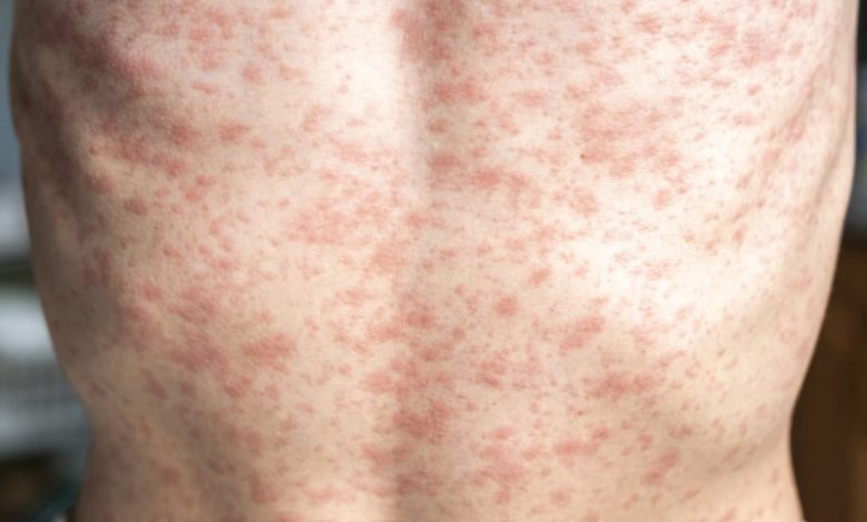 Portland shoppers avoid exposure sites amid measles outbreak Portland shoppers avoid exposure sites amid measles outbreak
