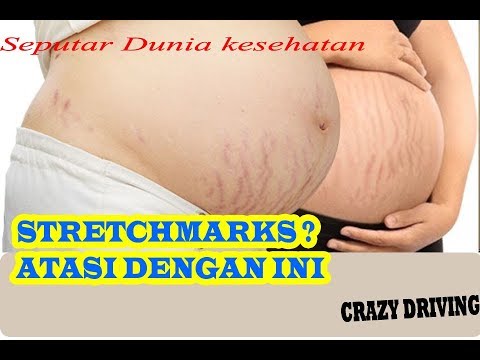Cara Alami Menghilangkan Stretch Mark Setelah Melahirkan Cara Alami Menghilangkan Stretch Mark Setelah Melahirkan