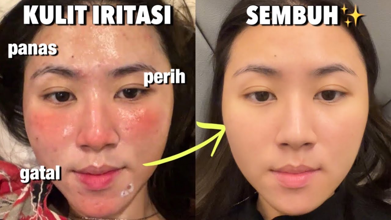 Cara Mengatasi Kulit Wajah Yang Mudah Iritasi Cara Mengatasi Kulit Wajah Yang Mudah Iritasi