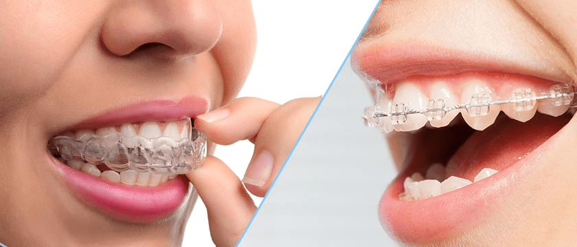 What are the Advantages of Invisalign Braces Over Traditional Braces? What are the Advantages of Invisalign Braces Over Traditional Braces?