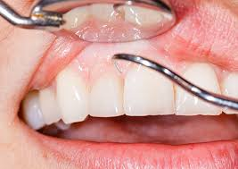 The Benefits of Laser Gum Surgery: A Revolutionary Approach to Periodontal Care The Benefits of Laser Gum Surgery: A Revolutionary Approach to Periodontal Care