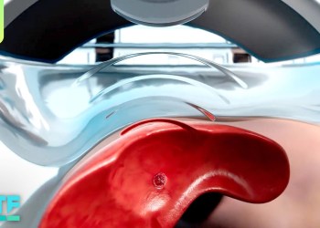 Destroying Tumors with SOUND: Histotripsy Demo & Explainer Destroying Tumors with SOUND: Histotripsy Demo & Explainer