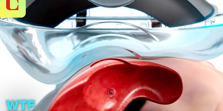 Destroying Tumors with SOUND: Histotripsy Demo & Explainer Destroying Tumors with SOUND: Histotripsy Demo & Explainer