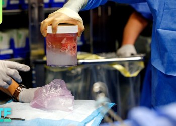 Xenotransplants: Human Receives Gene-edited Pig Kidney Xenotransplants: Human Receives Gene-edited Pig Kidney