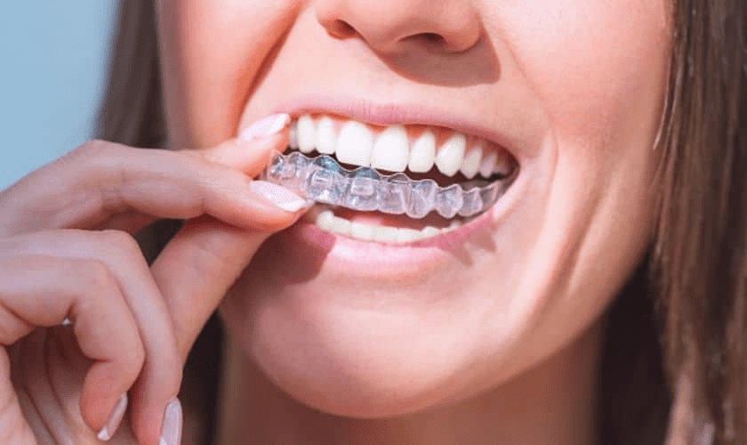 Invisalign: A Revolutionary Approach to Teeth Alignment Invisalign: A Revolutionary Approach to Teeth Alignment