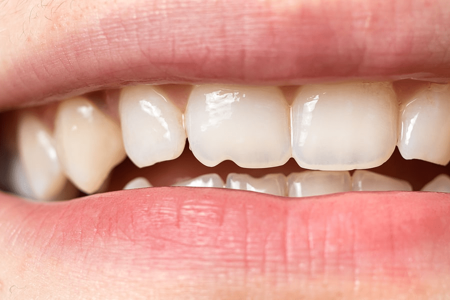 The Advantages of Composite Bonding Over Other Cosmetic Treatments The Advantages of Composite Bonding Over Other Cosmetic Treatments