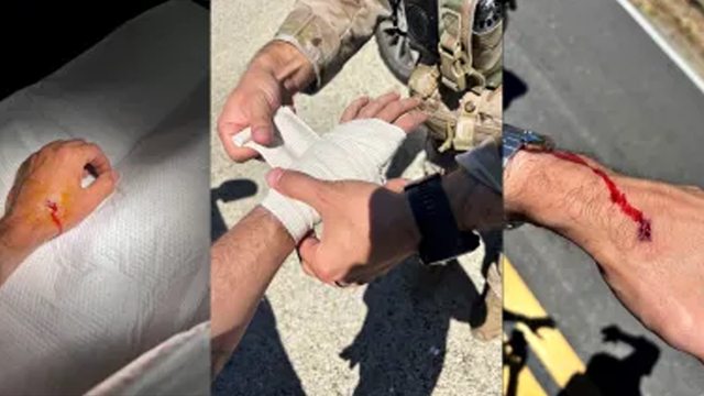 Injured ICE officer's hand, lacerated by a rock thrown during a riot incited by Rep. Carbajal’s doxxing at a California marijuana facility raid. Injured ICE officer's hand, lacerated by a rock thrown during a riot incited by Rep. Carbajal’s doxxing at a California marijuana facility raid.